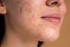 Acne Comprehensive Guide