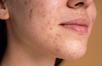 Acne Comprehensive Guide