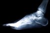 Plantar Fasciitis Explained