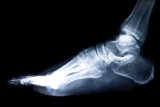 Plantar Fasciitis Explained